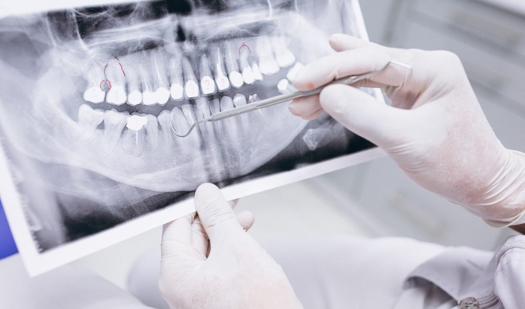 implantes salamanca navarro clínica dental 